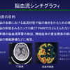 じじぃの「科学・芸術_995_脳死・脳血流SPECT検査」