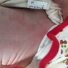 乳児性湿疹