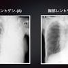 ECG-178：左の肺が見えない２症例での心電図です。