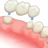 歯の治療　思ったより時間が掛かりそうだ。