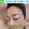 帯状疱疹で失明って怖すぎる 疲れとストレスがトリガー コロナワクチン被害は怖い