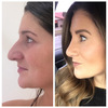 How to Recover From a Rhinoplasty Surgery