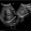 腎の先天異常。腎のエコー画像。腎門部が腹側に？？
