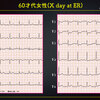 ECG-357：同じ病態を表す心電図のバリエーションです。 = 心電図検定試験：傾向と対策 Q.005 =