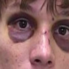 パンダの目（black eyes）は何故起こるか