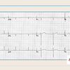 ECG-376：ある右軸偏位の鑑別です。レアものです。(#心電図検定試験-No.21)