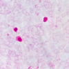 20230901：Vibrio vulnificus感染症