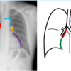 胸部レントゲンの心陰影の見方