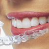 Niềng răng invisalign bạn nên lưu ý điều gì?
