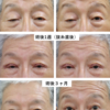 眼瞼下垂の典型症状と治療による改善