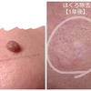 顔のほくろ除去の跡が消えない！レーザーから1年後の画像