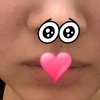 CO2レーザーでホクロ除去してみた 1ヶ月後