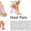 What Is Plantar Fasciitis