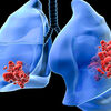 Lung Cancer Treatment Explored