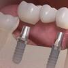 Are Dental Implants Worth It? 