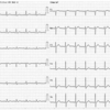 ECG-096：63才男性。Multiple-Risk患者の胸痛発作でした。