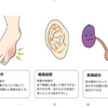 現代版痛風の原因