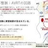 不整脈：上室性頻脈(SVT)　AVRT(房室回帰性頻拍)について　　〜基本45〜