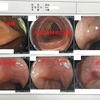 大腸の内視鏡検査を初めて受けてきました！　血便は痔と決めつけなかれ