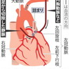 天皇陛下の心臓冠動脈バイパス手術成功