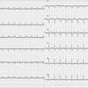 ECG-108：71才女性。呼吸苦でER経由での入院です。