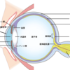 2023年2月　眼内レンズ摘出、多焦点眼内レンズ、網膜硝子体手術