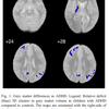 ADHDの灰白質と白質の体積