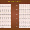 ECG-392： 〔#心電図検定試験  Question-13〕  この心電図のCAGは？