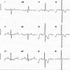 ECG-164：67才男性。電気軸測定(その６)