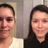 How to Get the Most Out of Tretinoin
