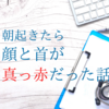 【教訓】朝起きたら顔と首が真っ赤だった話