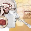 Avail the Best Endonasal Surgery for Removal of Pituitary Tumors