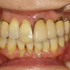 歯周病で歯が揺れて歯茎が下がってしまった方のための審美歯科治療の紹介