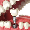 Instructions to Get Dental Implants To Last For Life