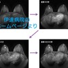 MRIの結果 - 通院②-2 [1ヶ月と10日目]