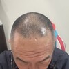 資本減耗ならぬ頭髪減毛だ！・・・着実に進む減毛に追加投資するかどう対処すべきか？