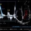 心エコー。左室流入速波形。パルスドプラ法。Ｅ/Ａ。Ｅ波とＡ波。L波とは？？