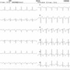 ECG-060：81才男性。突然の胸痛。