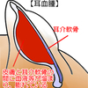 耳血腫とｲﾝﾀｰﾌｪﾛﾝ療法