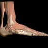 All About Achilles Tendinitis