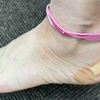 くるぶし下の痛みは腓骨筋腱炎じゃなかった・・・アキレス腱周囲炎の可能性