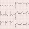 ECG-148：86才女性。胸部不快発作後に、ERを受診しました。