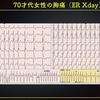 ECG-242：answer