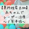 子どものレーザー治療は有効か？異所性蒙古斑の1年半後をご報告