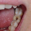 歯茎が膿む？根尖性歯周炎(こんせんせいししゅうえん) 3根 完治までの道のり
