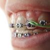 Top Dental Braces Choices