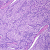 【論文チェック】Biphasic squamoid alveolar renal cell carcinoma (BSARCC) の報告例