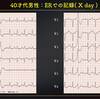 ECG-299：answer