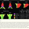 上気道の解剖学的構造および無呼吸低呼吸指数に対する体重減少の影響．舌脂肪の重要性