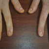 梅毒による爪症状